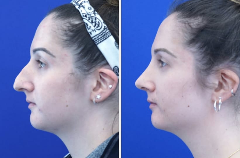 Rhinoplasty before and after, three months after surgery