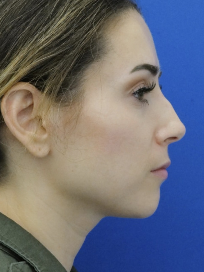 Mild Hump Reduction — Before