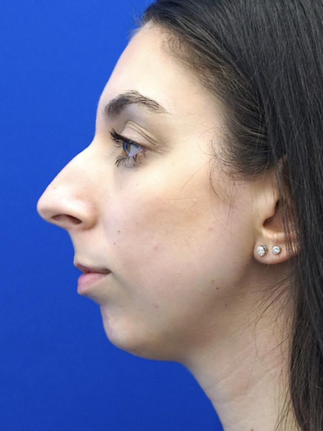 Facial Profile Balance — Before