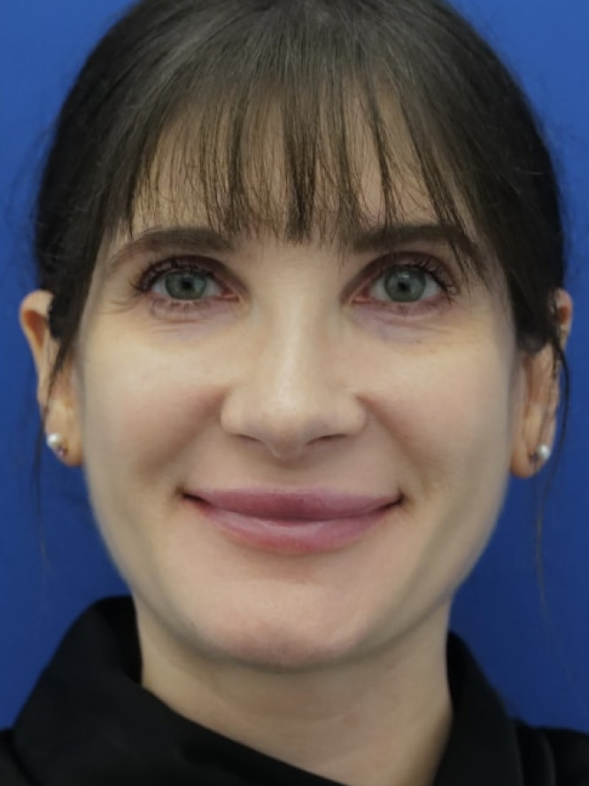 Preserving Tip Surface Aesthetics — After