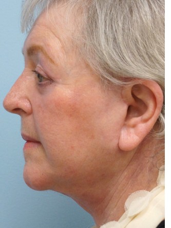 Aging Eyelid, Facelift, Necklift, Fractional CO2 Laser Resurfacing* — After