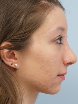 Prominent Nose Closed Rhinoplasty* — After