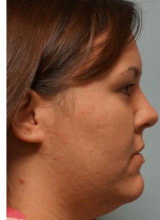Crooked Nose Endonasal Technique2* — Before