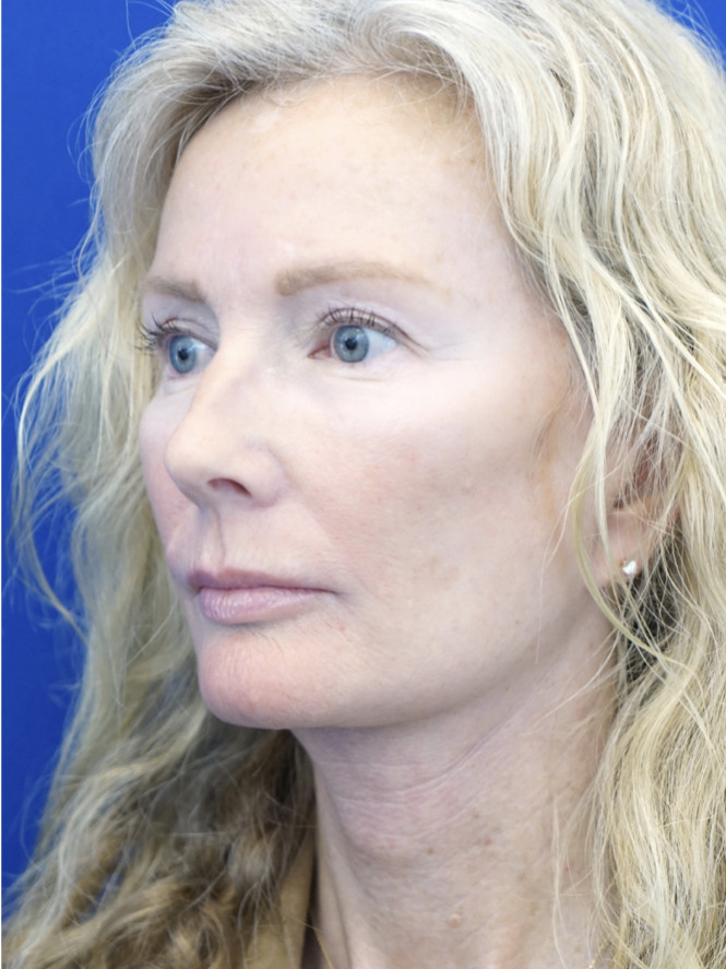 Scintillating Natural Result — After