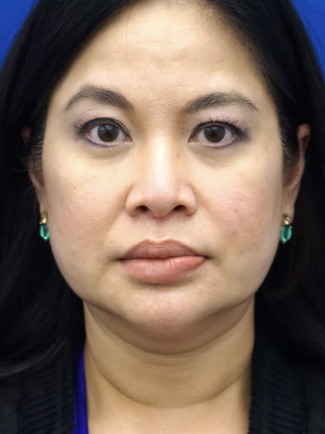 Brow Asymmetry — Before