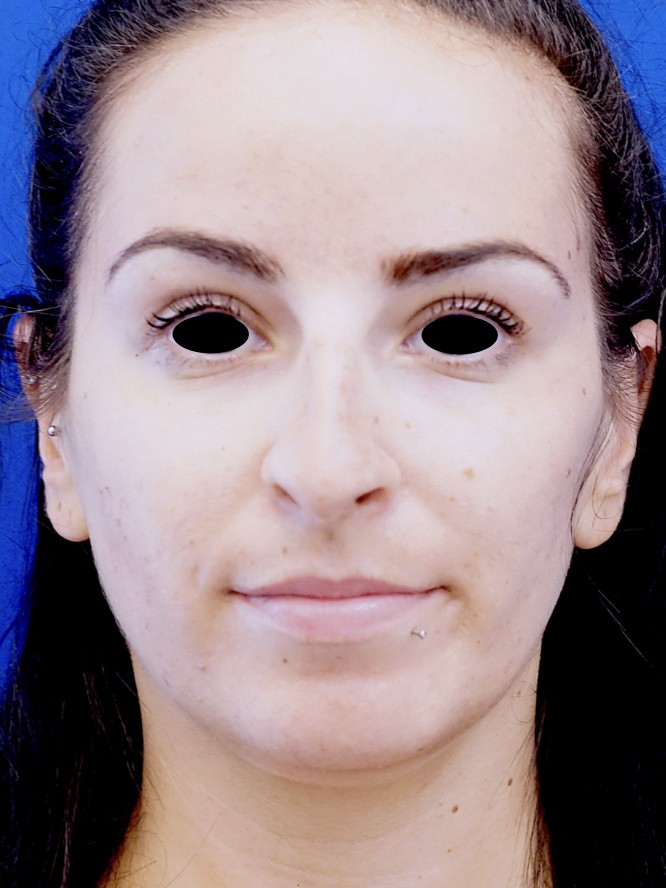 Nasal Tip Refinement — Before
