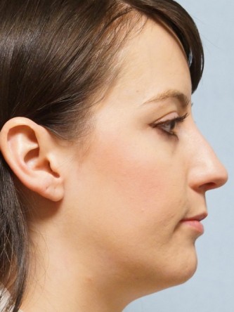 Repair of Nasal Septal Perforation* — Before