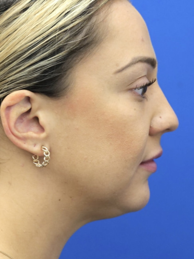 Lower Facial Rejuvenation — Before