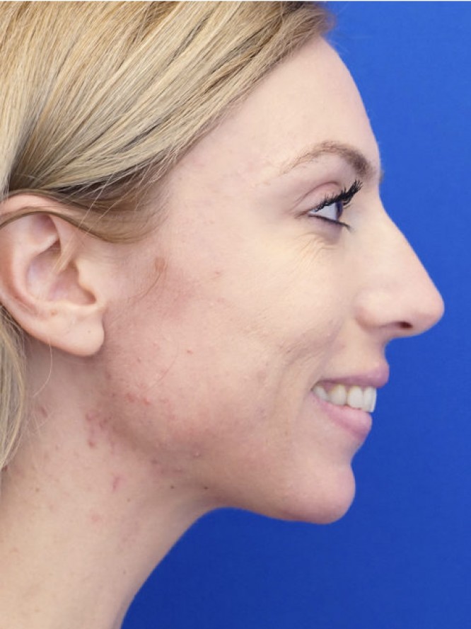 Endonasal Dainty Nose — Before