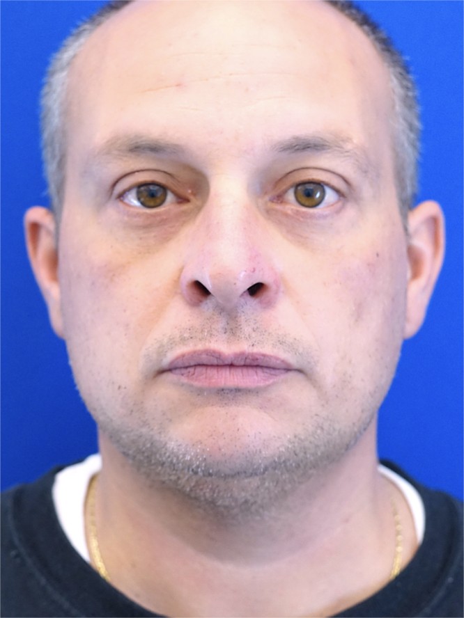 Orbital Fat Reposition — After