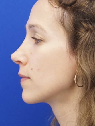 Long Nose Hanging Columella — After