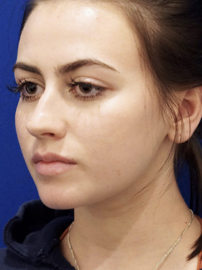 Smooth Dorsal Contour — Before