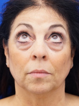 Lower Eyelid Fat Removal* — Before