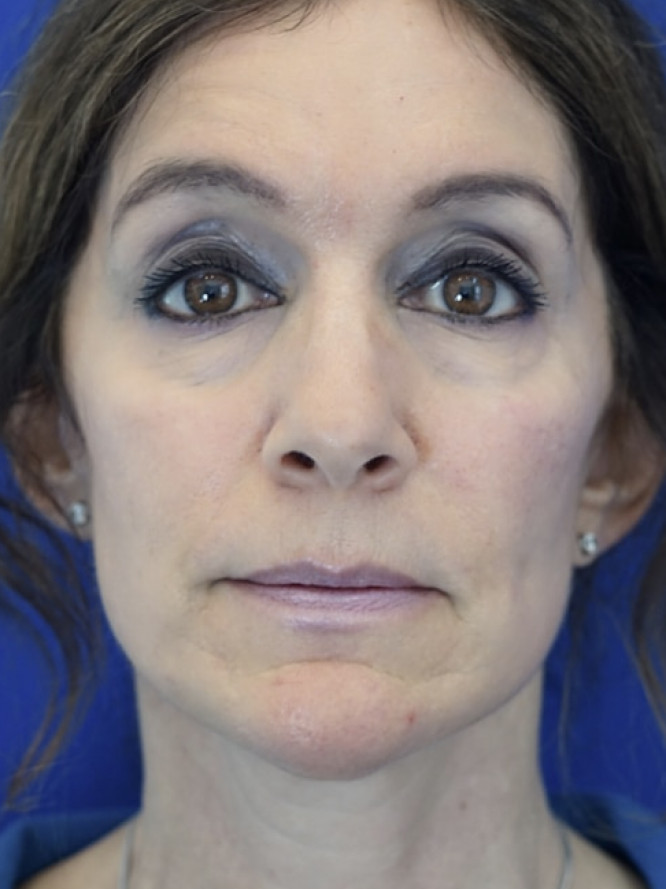 Endonasal Subtlety — Before