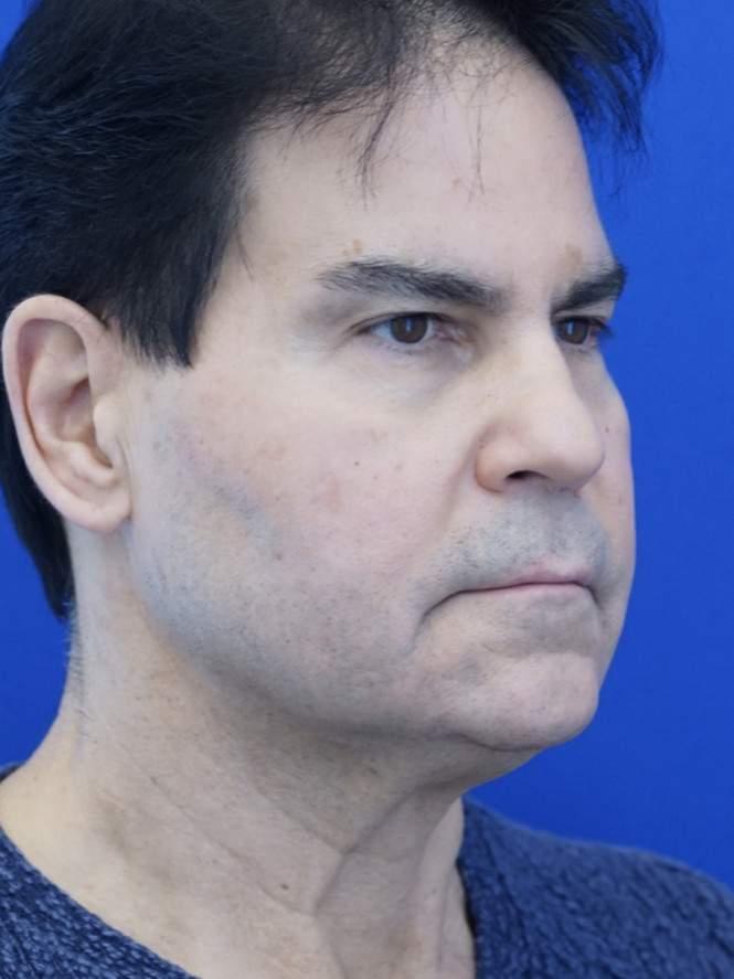 Male Facelift — Before