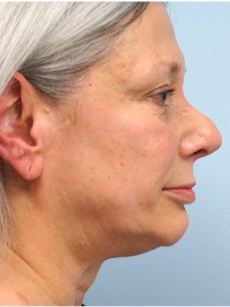 Over Projected Thick Skin Nose* — Before