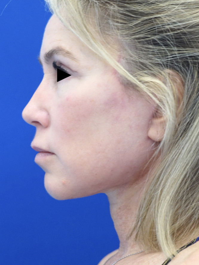 Deep Plane Facelift with Platysmaplasty — After