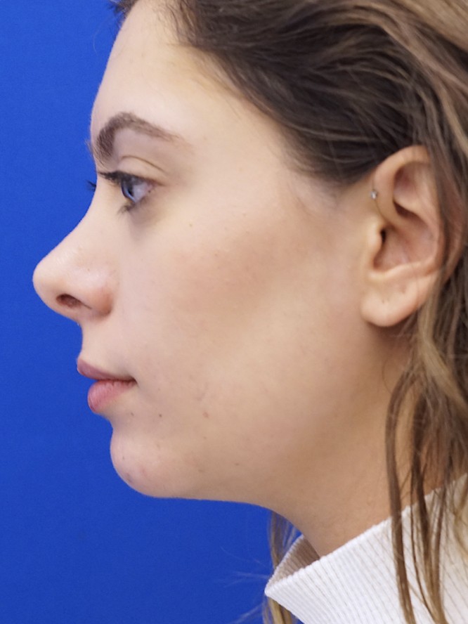 Hump Reduction and Chin Projection — After