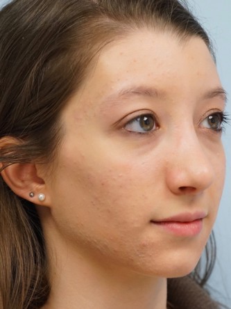 Prominent Nose Closed Rhinoplasty* — After