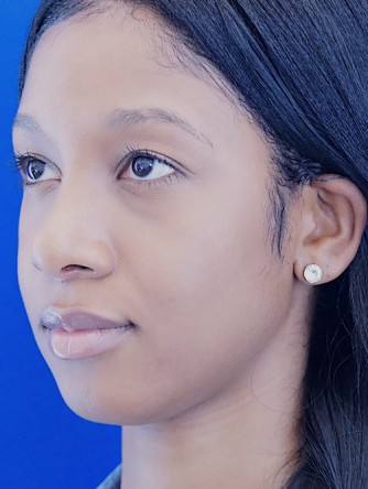 Ethnic Rhinoplasty* — After