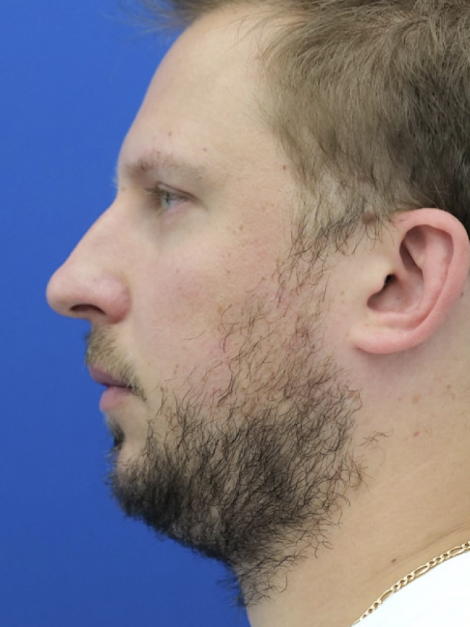 Dorsal Hump and Chin Augmentation — Before