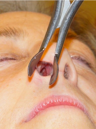 Nasal Septal Perforation2* — After