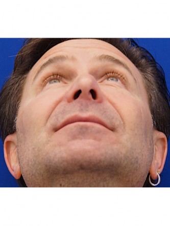 Nasal Tip Droop* — Before