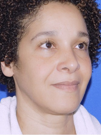 Ethnic Rhinoplasty* — After