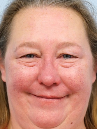 Upper and Lower Eyelid Blepharoplasty* — Before