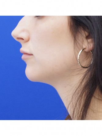 One Year Lip Filler Result — After