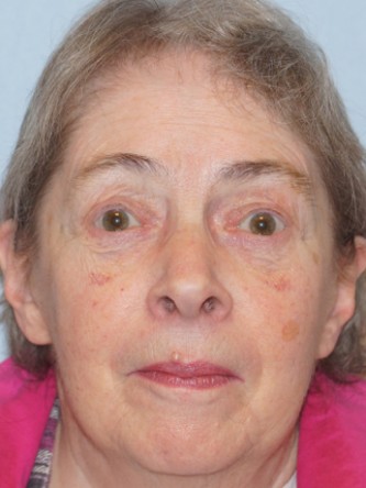 Visual Field Deficit – Eyelid Ptosis3* — After