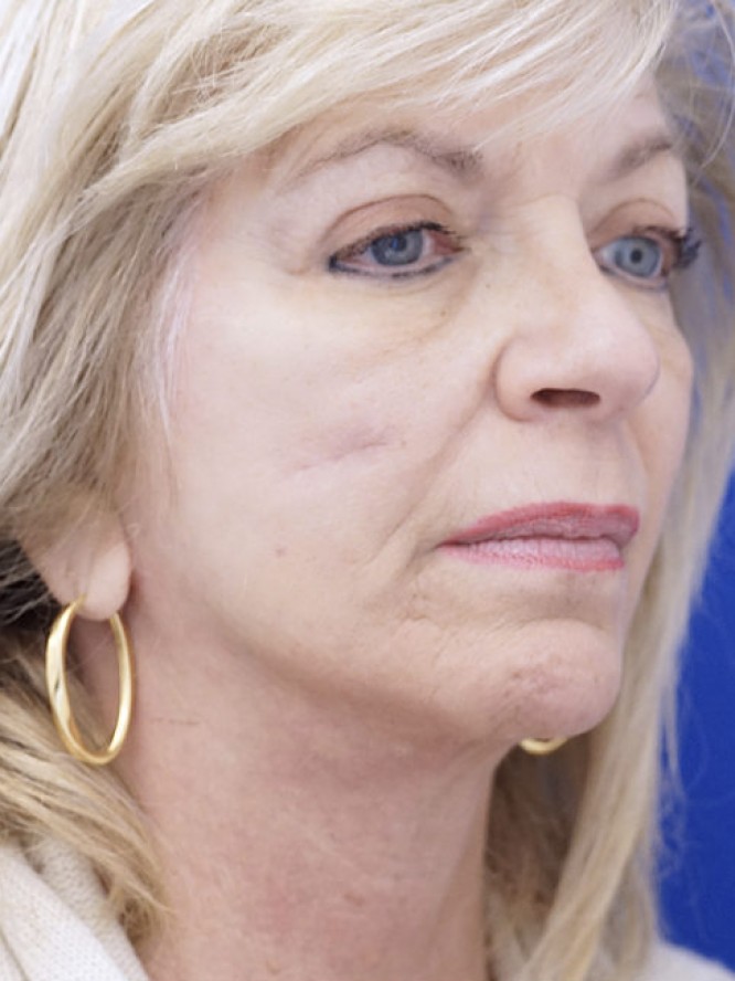 Jowls and Loose Neck Skin — After
