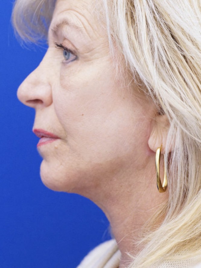 Jowls and Loose Neck Skin — After