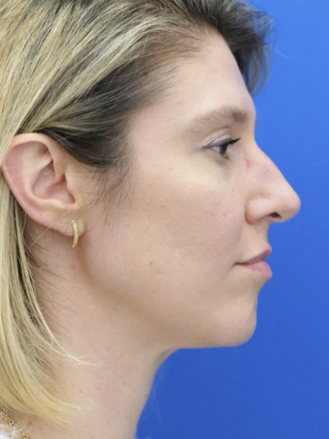 Dorsal Hump and Finesse Tip — Before