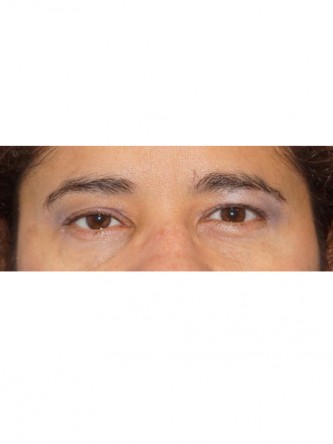 Right Ptosis Repair* — Before