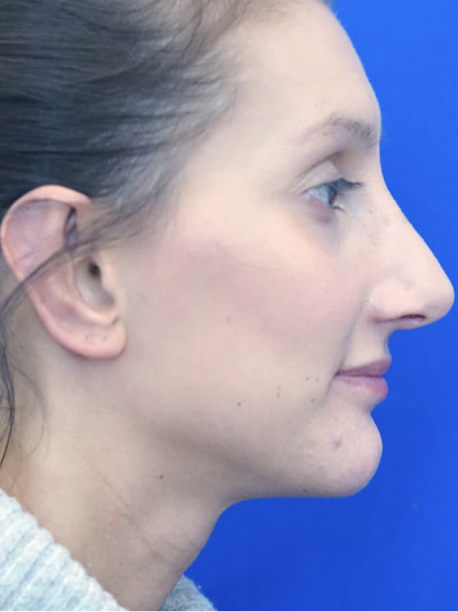 Ear Prominence — After