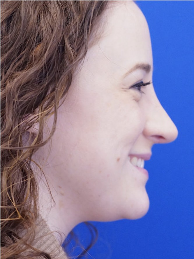 Finesse Nasal Contour — After