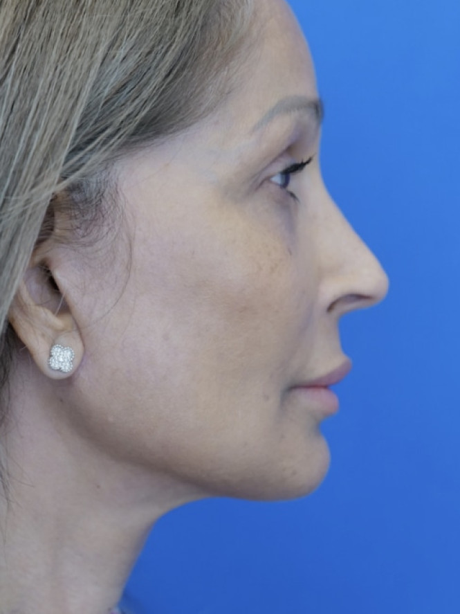 Face and Endobrow Lift — After