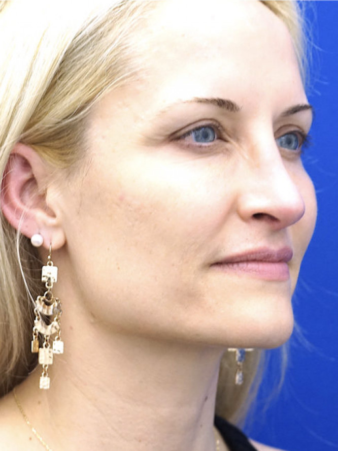 Nasal Profile Finesse — After