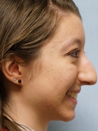 Prominent Nose Closed Rhinoplasty* — Before