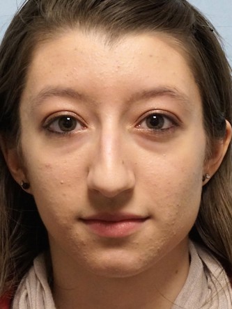 Prominent Nose Closed Rhinoplasty* — Before