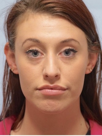 Cupid’s Bow Enhancement by Juvederm* — After