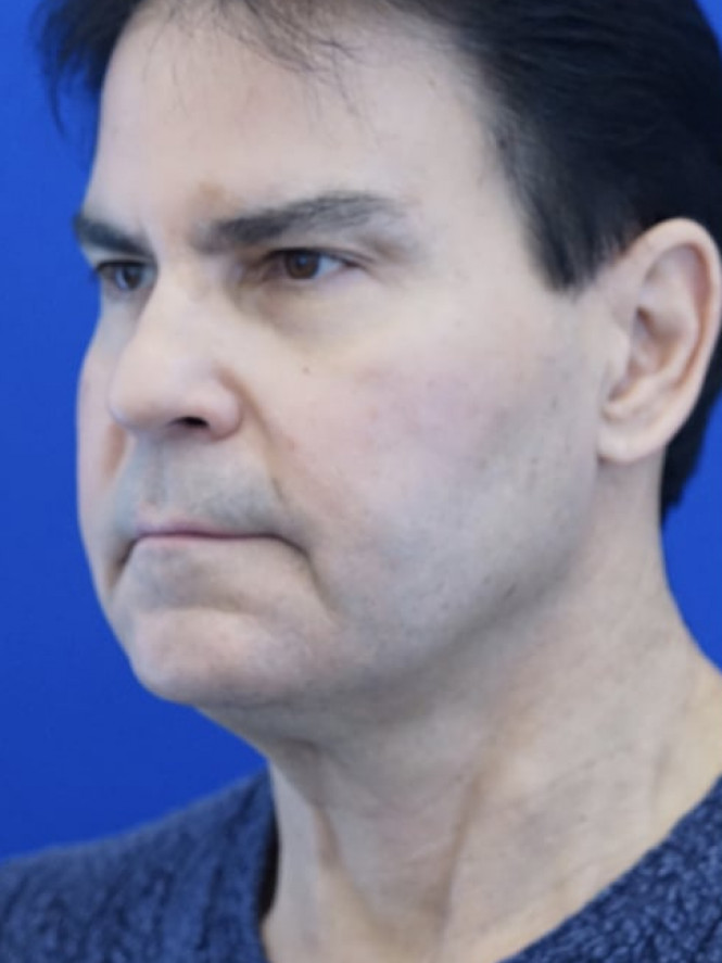 Male Facelift — Before
