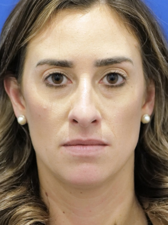 Preservation Rhinoplasty — Before