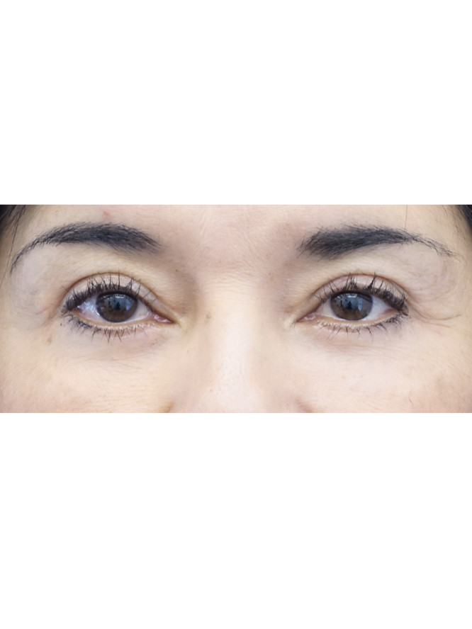 Four Quadrant Blepharoplasty with Fat Reposition — After