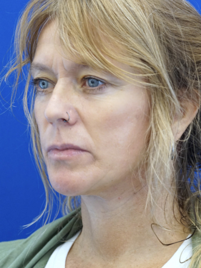 Fantastic Facial Profile — After