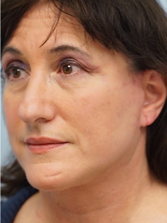 Mini Face and Neck Lift* — After