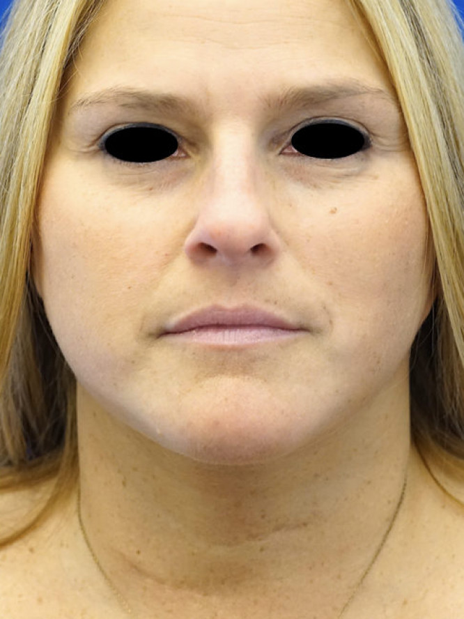 Deep Plane Lower Facelift and Platysmaplasty — After