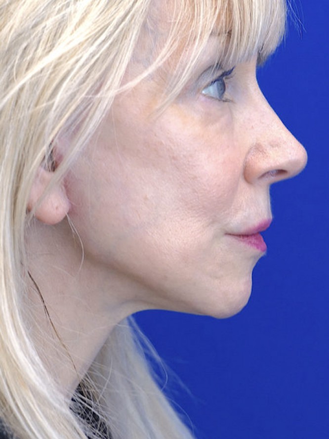 Crisp Jaw and Neck Lines — After