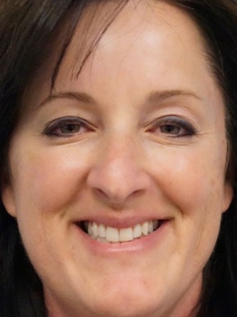 Botox Periorbital – Around the Eyes* — After